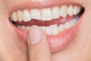 How to care for bonded teeth