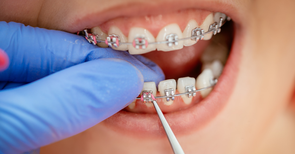 Most Common Reasons for Braces (Medical and Cosmetic)