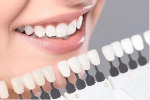 What Are the Benefits of Dental Veneers?