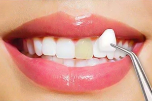 Who Needs Dental Veneers?