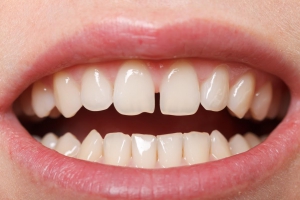 You Have Little Teeth Space.