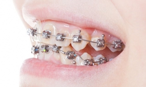 You Have an Underbite