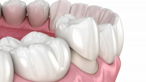 A dental crown makes your teeth more durable.