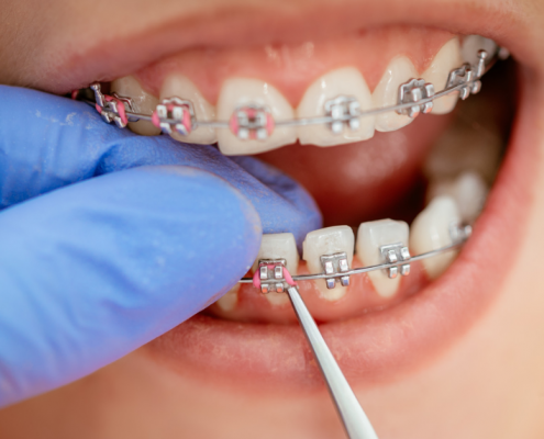 Most Common Reasons for Braces (Medical and Cosmetic)