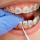 Most Common Reasons for Braces (Medical and Cosmetic)